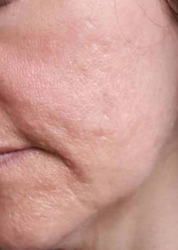 Facial Acne on cheeks and chin regions after