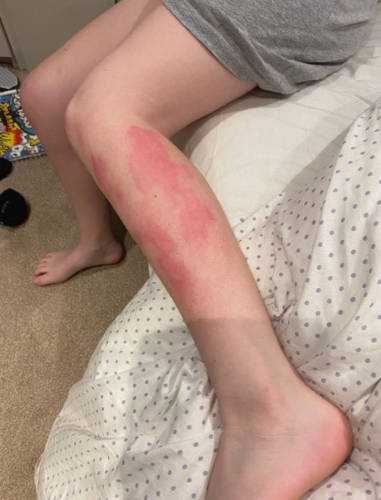 Scalding of Leg from Boiling Water during