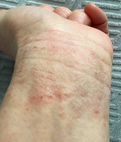 Skin irritation (around the inner wrist region) before