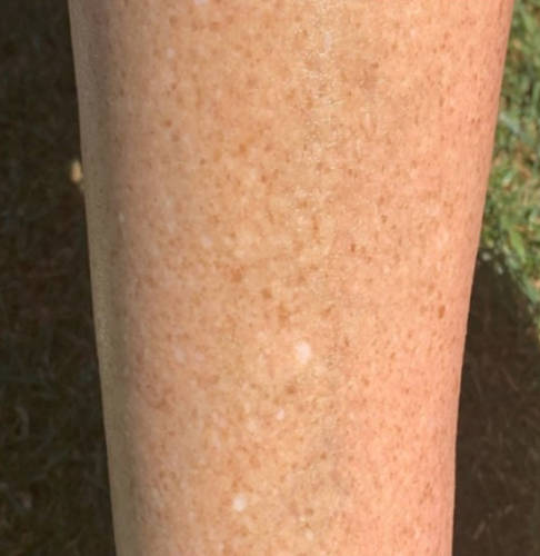 Dry, flaky skin on lower leg region after