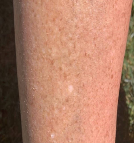 Dry, flaky skin on lower leg region before