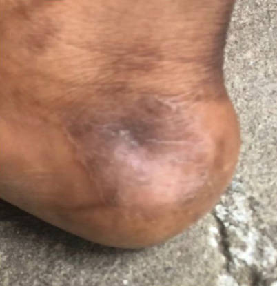 Fungal Infection On The Heel after