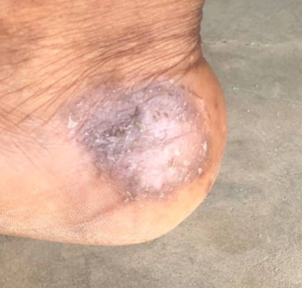 Fungal Infection On The Heel during