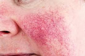 Rosacea information sheet